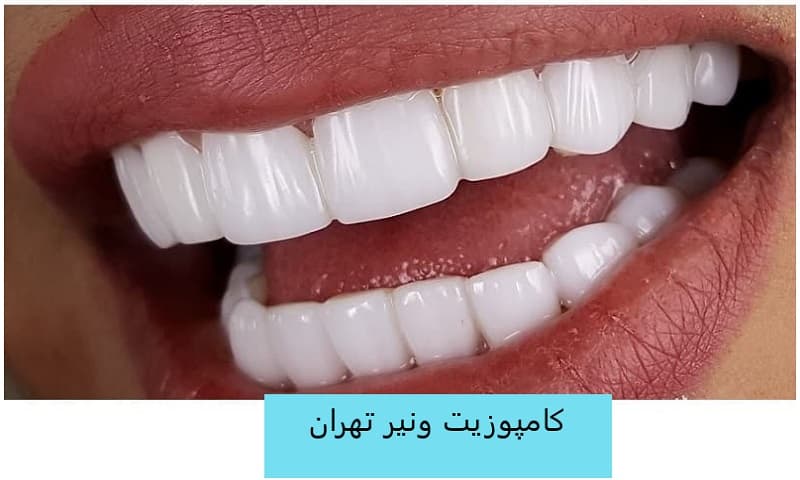 کامپوزیت ونیر سرامیکی