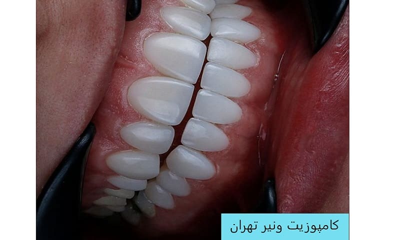 بهترین مارک کامپوزیت ونیر دندان