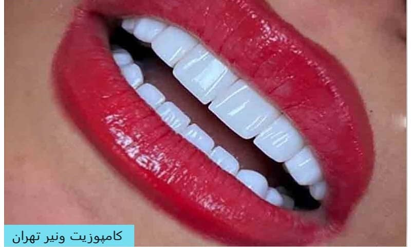 قیمت کامپوزیت ونیر