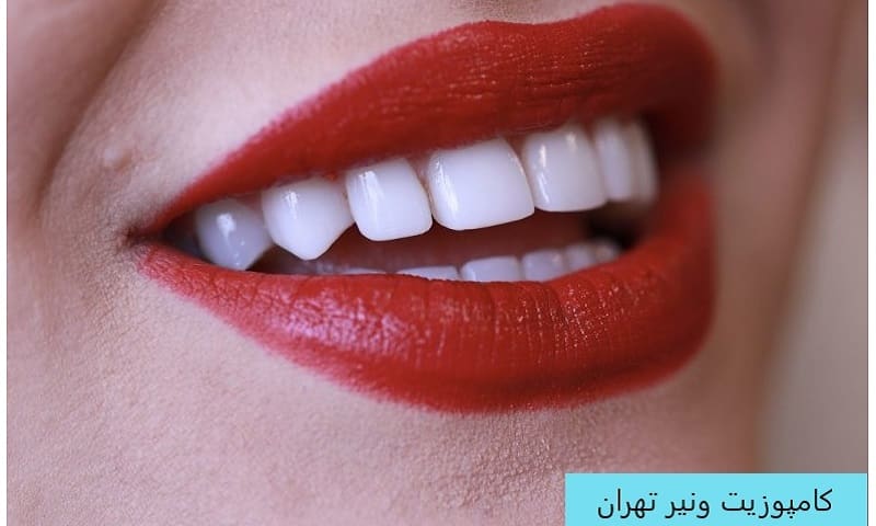 کامپوزیت ونیر