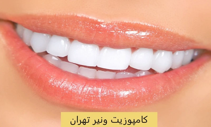 کامپوزیت ونیر تهران - قیمت بهترین مارک Composite veneer کامپوزیت ونیر تهران - قیمت بهترین مارک Composite veneer